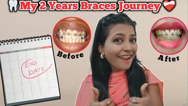 🥺My 2 Year Complete with Braces ll The Braces Countdown: When Will MyTreatment Actually End?