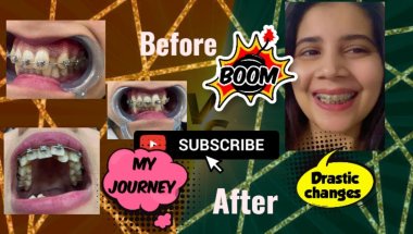 My 1 year braces journey pain/Cost/time/teeth extraction 🥳🦷🩺 #teeth #trending #youtube #viral