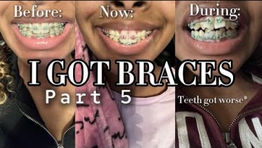 I GOT BRACES!! Part 5 | my raw and realistic experience | Brya Life