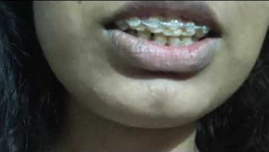 My 8 months braces jounery 🥰🥳() #braces #love #smiledesigndental #tranformation #youtube #duet #life