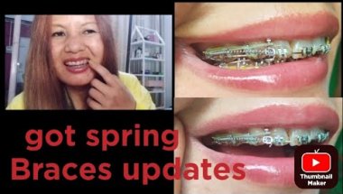 Braces updates got spring today, change powerchain #adultbraces #bracesupdates #updatestime #braces
