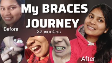 My New Smile! ✨22 Month Braces Journey 🦷 Goodbye Braces! 😵‍💫#bracesjourney