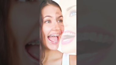 Sapne Me Daat Me Braces Dekhna|सपने में दात में ब्रेसेज देखना #sapneme #सपने #shortsfeed #viral