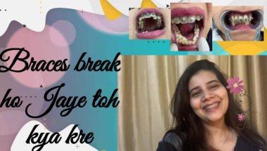 Braces tut jaye toh kya kre😲🥲🦷#viral #trending #teeth #transformation #dentalcare