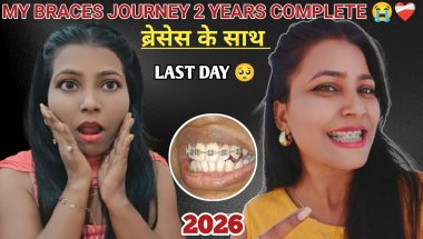 🦷🥺My Braces Journey 2 Years Complete 2026 ll ब्रेसेस के साथ लास्ट दिन 😭 ll Nd Family Vlogs #braces