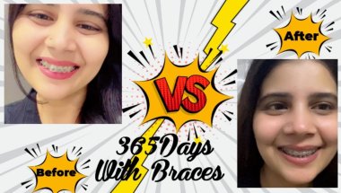 365days with braces before and after i still can’t believe it😲🦷#viral #youtube #toptrending #