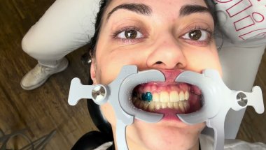 Invisalign Start: So werden Attachments geklebt 😍 Meine Aligner Reise beginnt!