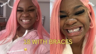 I Got Braces at 18… Did I Mess Up?