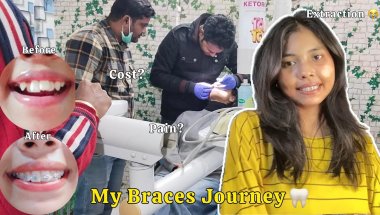🦷 My Braces Journey 2026 | Cost, Types of Braces, Pain 😰 | 6 Months Real Experience & Results