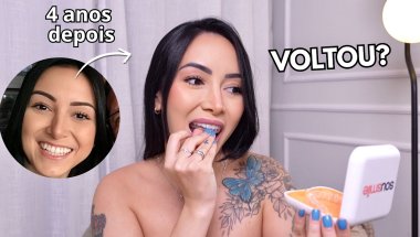 meu sorriso mudou pra sempre? 4 anos depois do tratamento com aparelho invisível