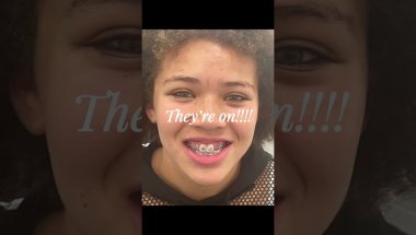 Braces (super late)