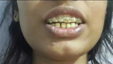 My braces experience🥰!my thoughts🤔💭 #braces #smiledesigndental #love #bracestransformation #dentist