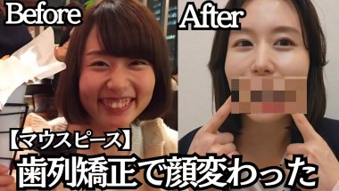 【整形級】マウスピース矯正で大きな変化