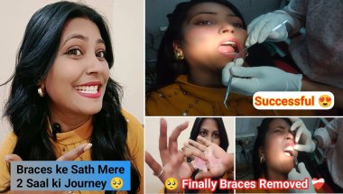 Braces Journey Completed ll Braces Nikal Gaye 2 Yr Ki Mehnat Ka Result 😍 28 feb 2024 To 25 feb 2026
