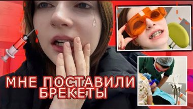 МНЕ ПОСТАВИЛИ БРЕКЕТЫ!! История моих страданий…