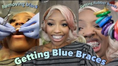 GETTING BLUE BRACES WITH RUBBER BANDS… I hate the rubber bands *COME WITH ME*