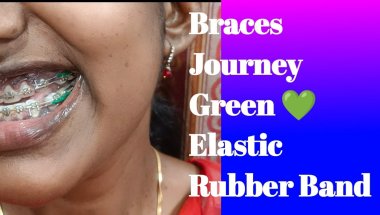 March 4, 2026 Braces Journey Elastic Rubber Band @kanaparthiravana1166