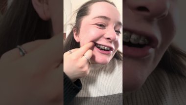 How I put my bands on my braces as a blind person