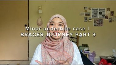 Minor underbite case | BRACES JOURNEY PART 3