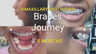 Bimaxillary Protrusion -Braces journey with premolar extraction - 5 months progress - Part 1