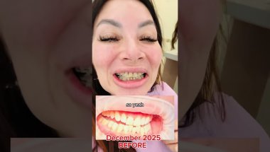 My 1 5 month braces at 56 results so far