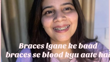 Braces lgane ke baad teeth se blood 🩸 kyu nikalte hai#viral #dentist #trending #dentalcare #teeth