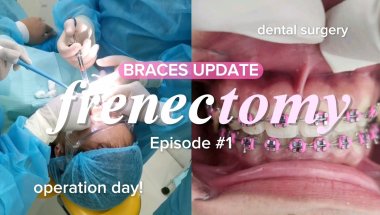 #BracesUpdate🦷: Frenectomy Surgery Day! (an operation I didn't expect)