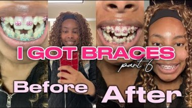 I GOT BRACES! Part 6 | retighten and removing coil springs | Brya Life