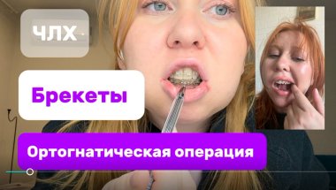 Подготовка к ортогнатической операции,неудачное брекет лечение,дистальный прикус,2 скелетный класс