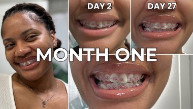 I Thought Braces Would Make Me Look Immature | 4 Weeks Later