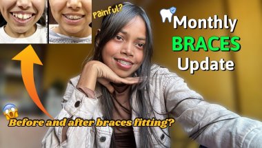Monthly Braces Checkup | 😱before and after results?