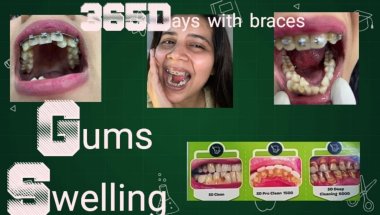 Braces lagwane ke baad gums swelling ho gya#viral #trending #dentist #dentalcare #youtube #teeth