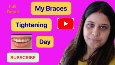 My Second Month Braces Tightening Update 😬 | Pain, Changes & Experience