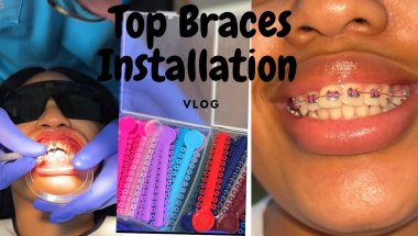 #vlog | Top Braces Installation 🦷 # braces