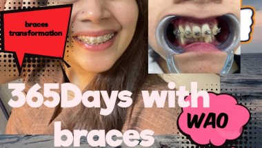 Ceramic braces keisa hota hai#viral #dentist #dentalbraces #trending #dentalcare #youtube #teeth