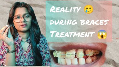 Braces treatment ke समय😓 ...ki reality 😰😱