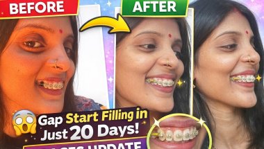 My braces journey|Gap start filling in just 20 days😍|braces update 🥰