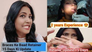 Braces Journey Completed ll Braces Ke Baad 15 Days Retainer Ke Sath  Experience 😍 #braces #retainers