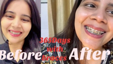 12 Months 12 days braces journey #viral #dentist #trending #dentalcare #toptrending #youtube