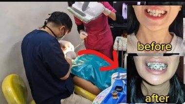 I Got Braces | Braces Journey Part 2 | Braces Vlog