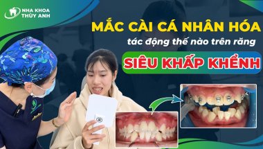 Hệ Thống Mắc Cài Damon Có Tác Dụng Gì Với Ca Niềng Răng Siêu Khấp Khểnh Có Nhổ Răng?