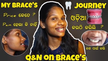 My brace's🦷 journey ||cost,type of Brace's, pain, 2026 |Q&A with real experience only 14 day
