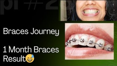 My Braces Journey 😬 | Finally Lower Braces | 1 Month Update
