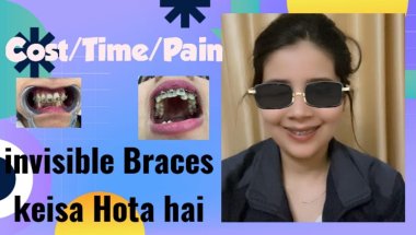 Invisible Braces keisa hota hai Cost/pain/Time/#viral #dentist #youtube #trending #dentalcare #saksh