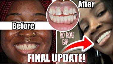 MY INVISALIGN BRACES FINAL UPDATE VLOG! (CLOSING MY GAP)