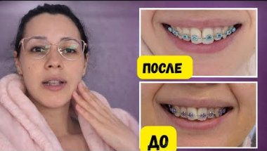 Как быстро работают брекеты? Мой результат через 6 недель
