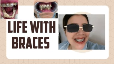 My one year life with Braces #viral #dentist #trending #dentalcare #teeth #youtube #toptrending