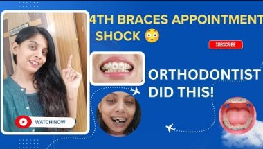 4th Braces Appointment 😳 Got Bite Blocks! Can’t Eat Properly Now #braces