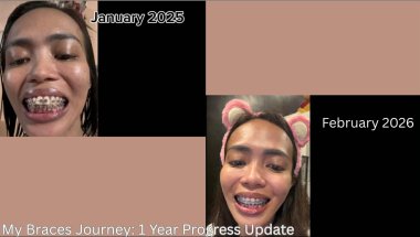 1 Year With Braces | Before & After Transformation