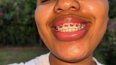 Vlog | Diary Session | Apology | Teeth mExtraction🦷 | Braces Update| Store Run| Haul🍦| Injections💉